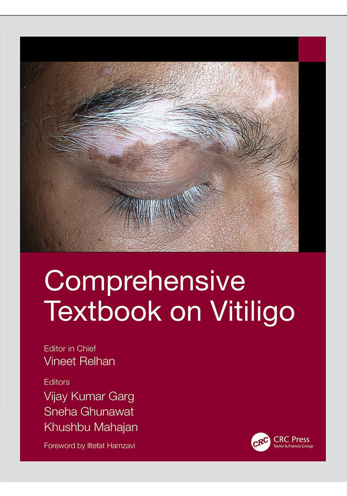 Comprehensive Textbook on Vitiligo