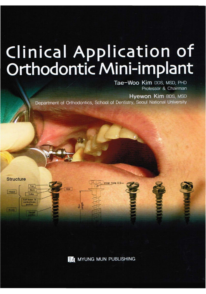 Applications of Orthodontic Mini Implants